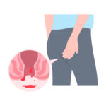 Homeopathic Treatment for hemorrhoids